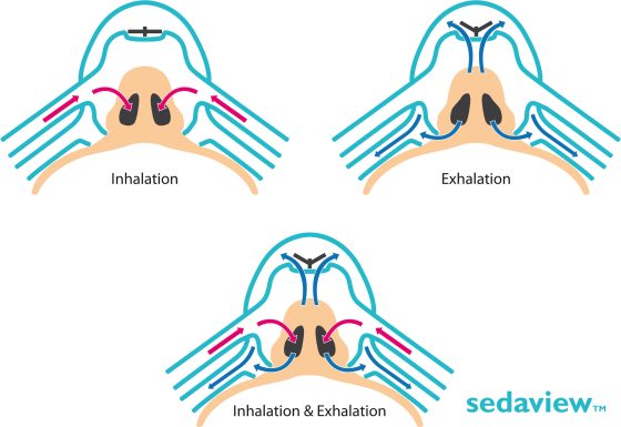 Máscaras Sedaview | Sistema de Sedação | 12un | ACCUTRON