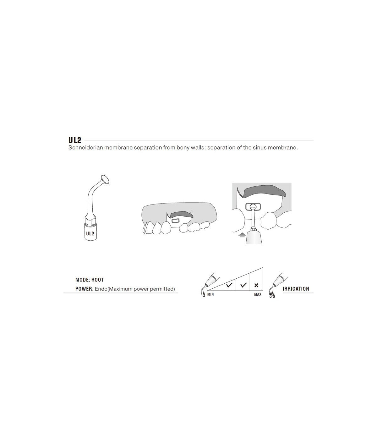 Ponta de Cirurgia para Separação da Membrana Sinusal | WOODPECKER