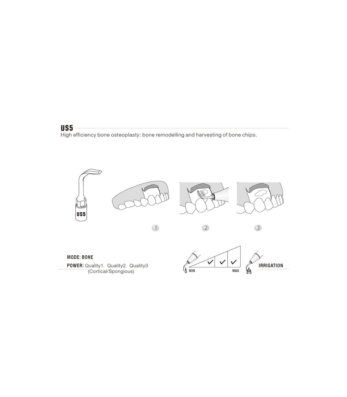 Ponta de Cirurgia para Osteoplastia | WOODPECKER
